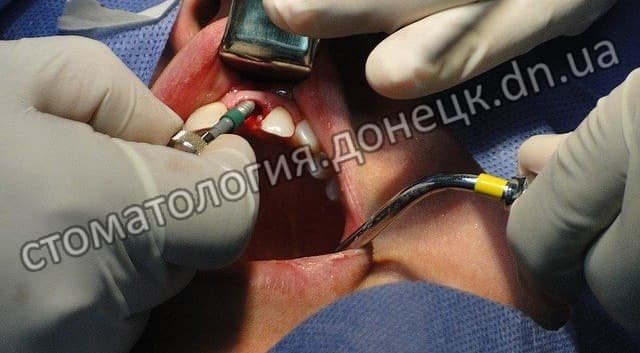 импланты зубов в Донецке