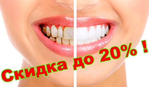 отбеливание зубов Донецк