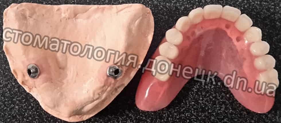 протезирование зубов Донецк